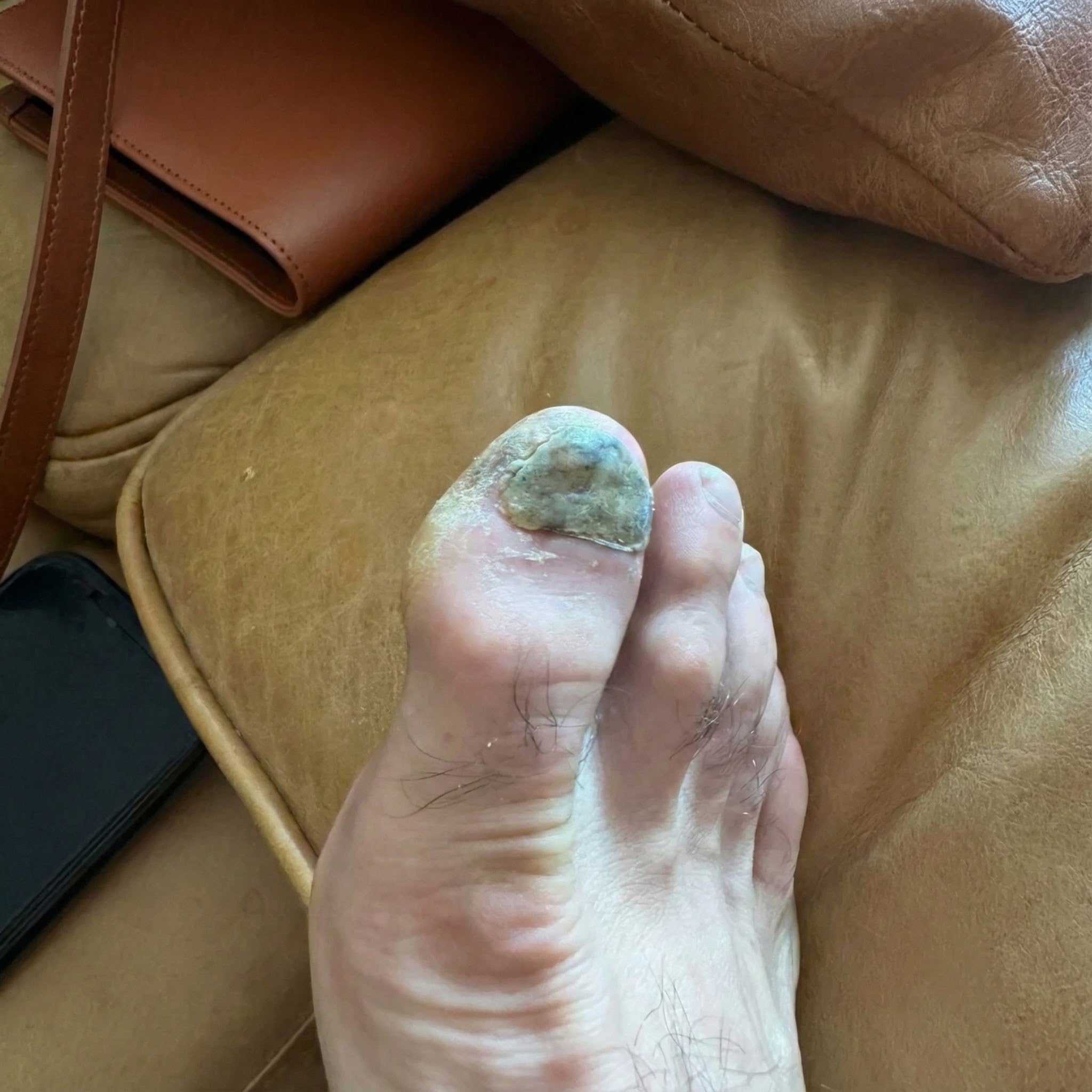 Close view of an affected toenail